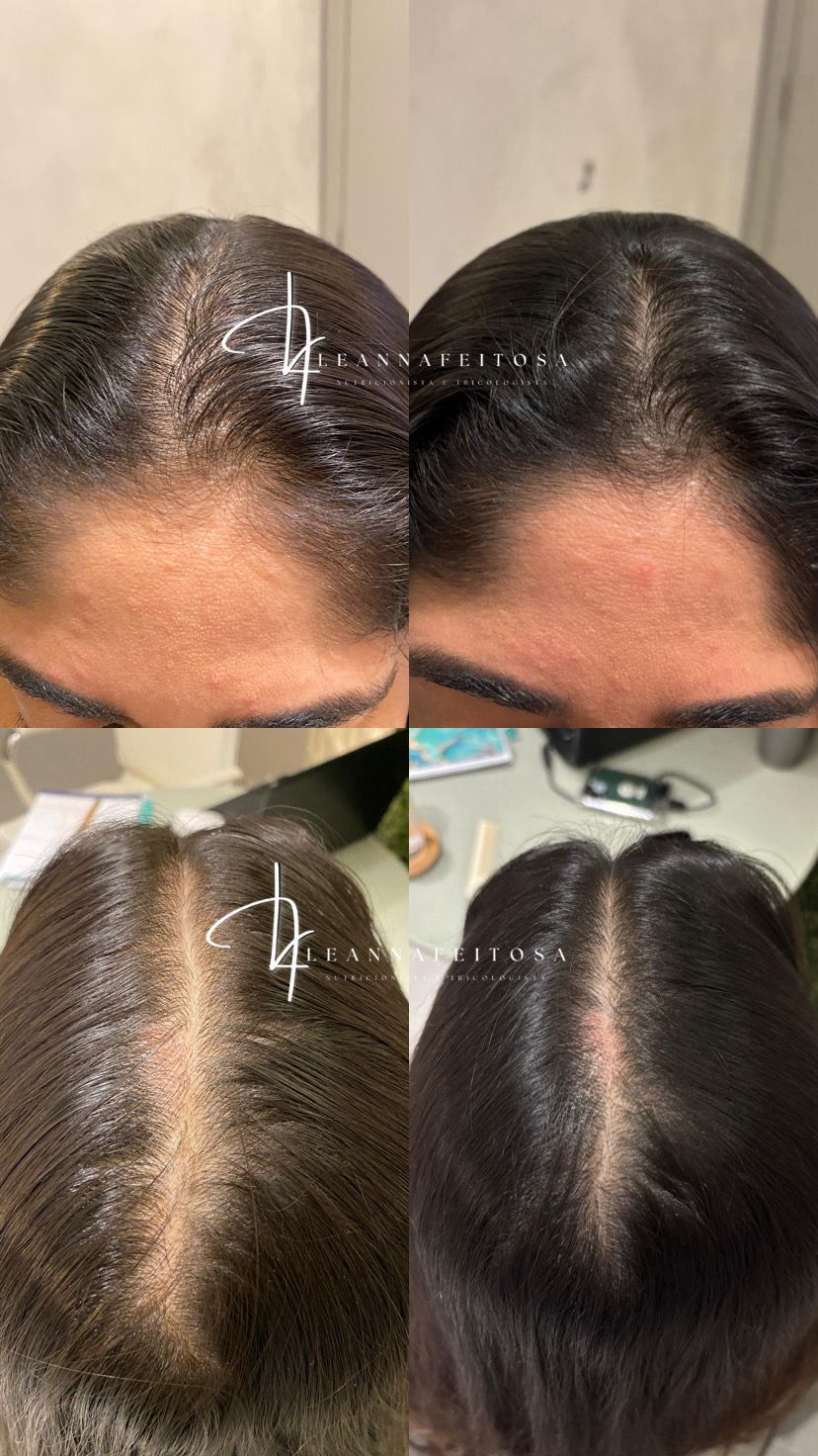 Tratamento para Queda de Cabelo