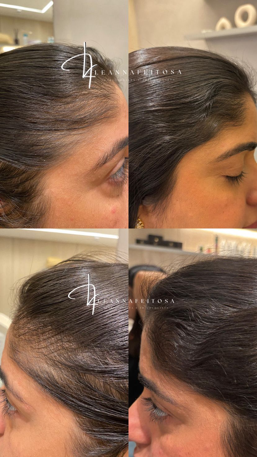 Tratamento para Queda de Cabelo