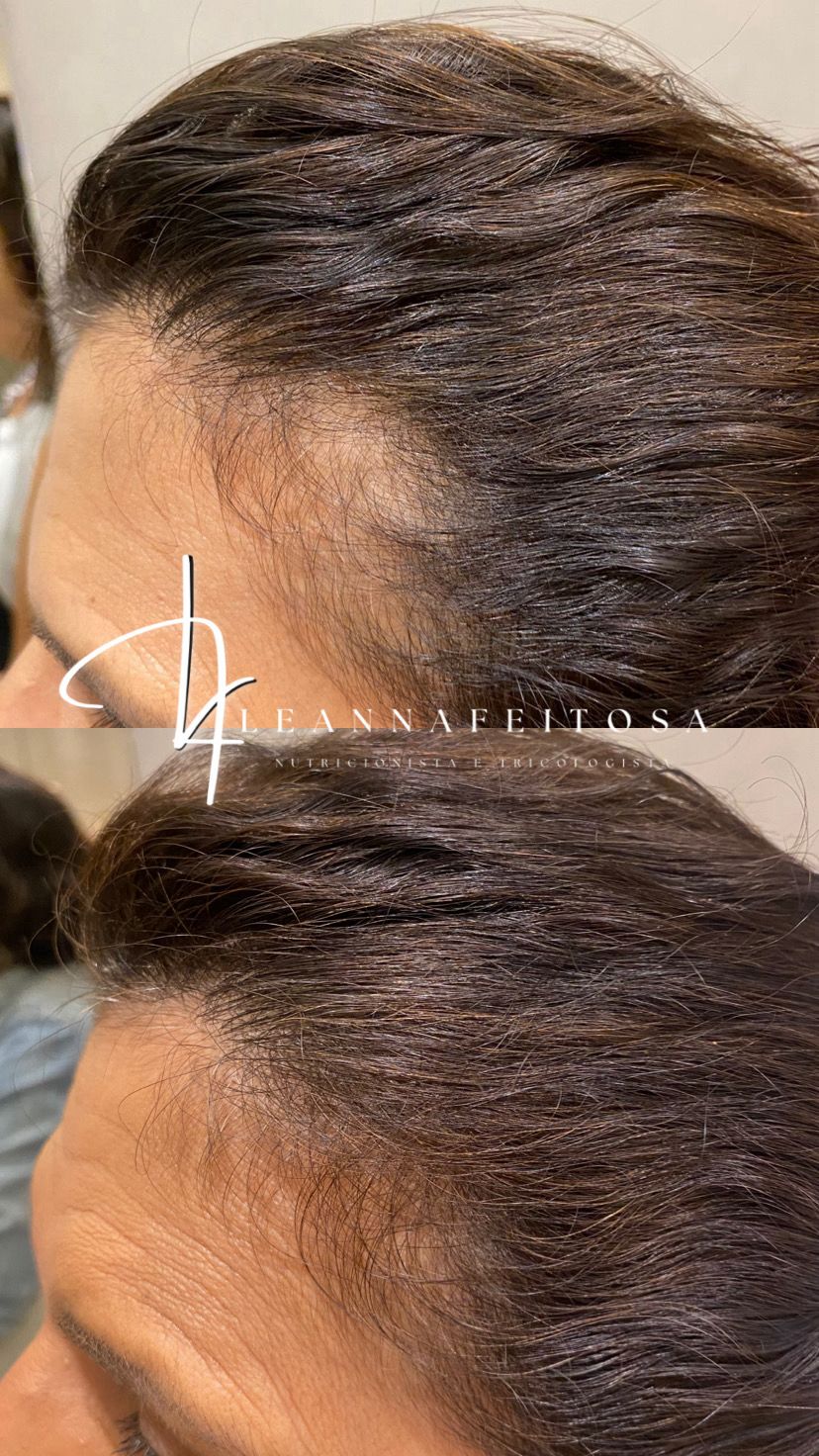 Tratamento para Queda de Cabelo