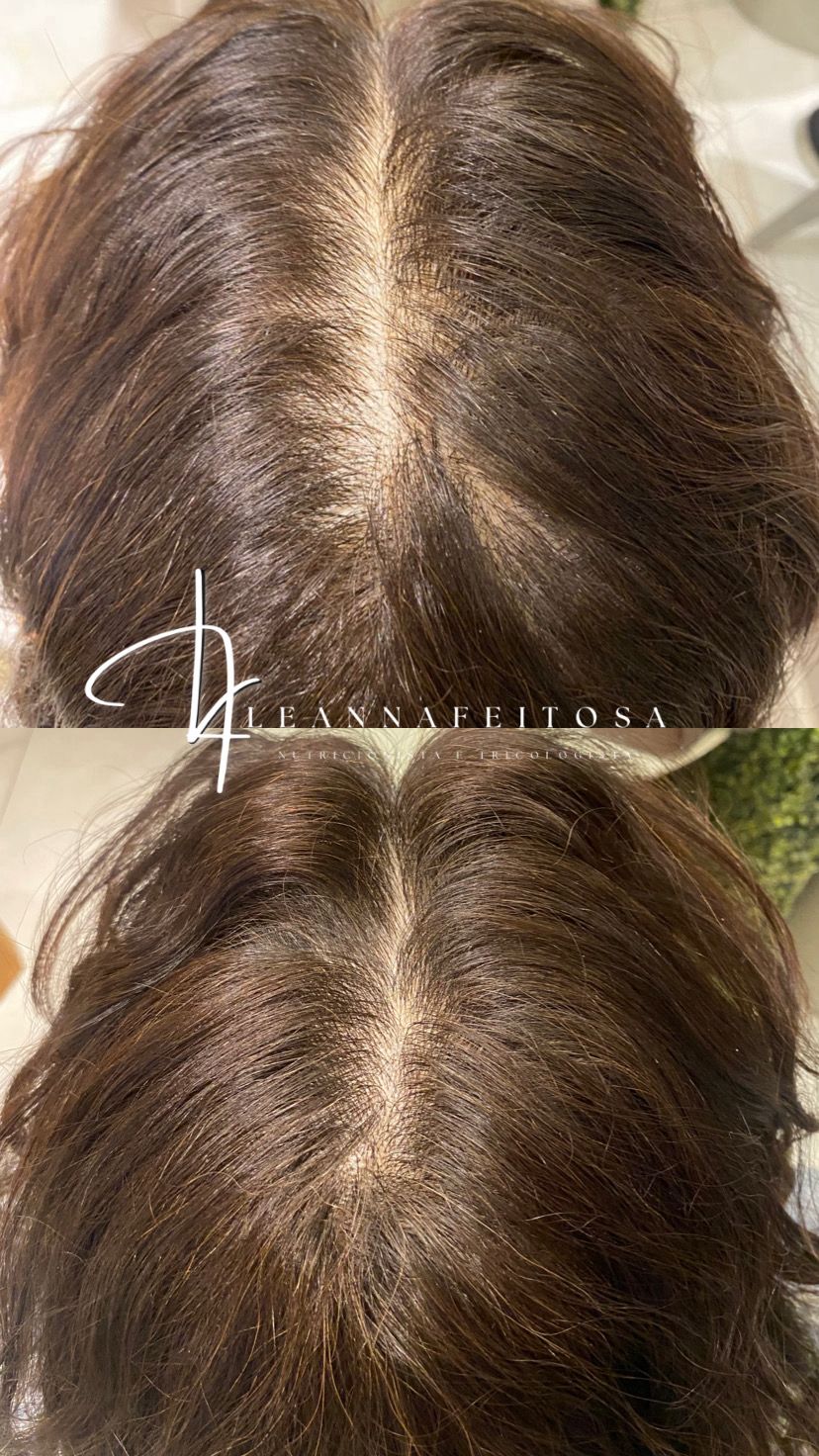 Tratamento para Queda de Cabelo